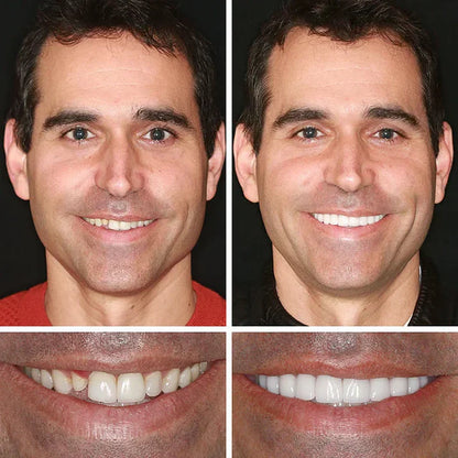 🌎Ends Today: 70% OFF! ⏰ Medical Full Denture with Strong Suctiond🦷Obtain American Dental Association (ADA) Certification